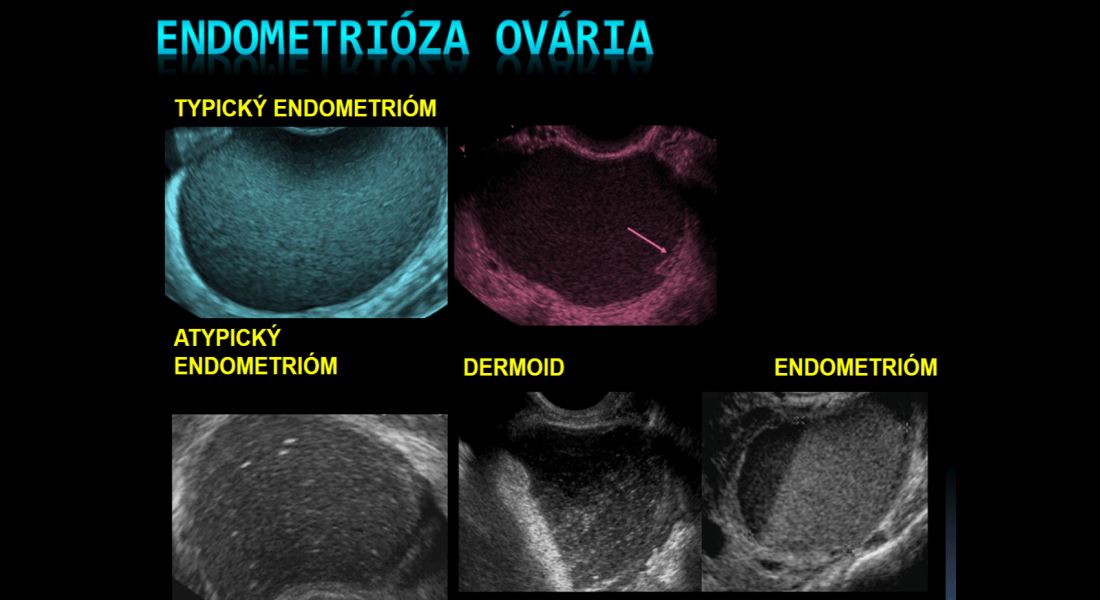 Endometrióza ovária