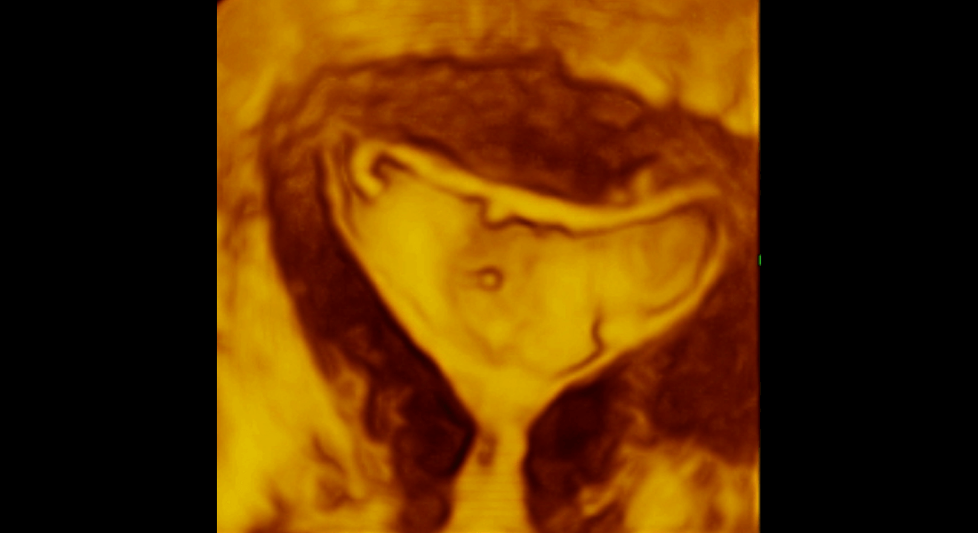 3D - Polypóza endometria