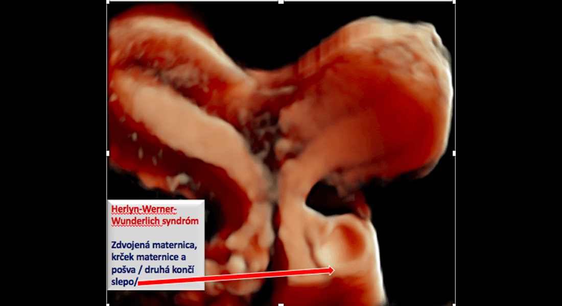 Herlyn-Werner-Wunderlich syndróm - Zdvojená maternica, krček maternice a pošva /druhá končí slepo/