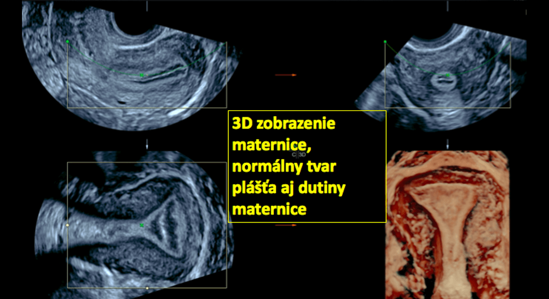 3D zobrazenie maternice, normálny tvar plášťa aj dutiny maternice